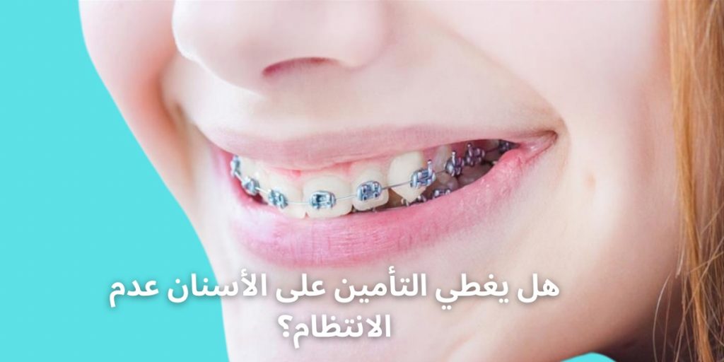 هل يغطي التأمين على الأسنان عدم الانتظام؟